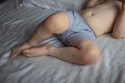Bệnh ngoài da do nhiễm virus có thể gây biến chứng gì?